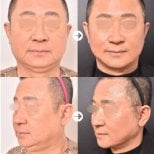 Resultados de minilifting facial antes y después en VG Plastic Surgery, rejuvenecimiento facial