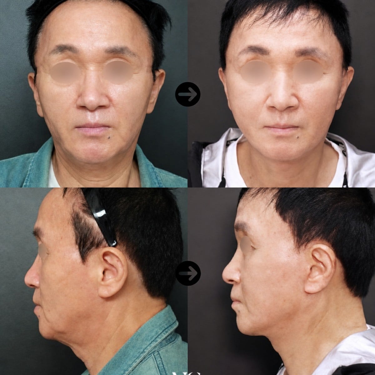 Resultados de minilifting facial antes y después en VG Plastic Surgery, rejuvenecimiento visible