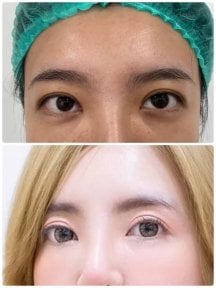 Before and after blepharoplasty results at ID Clinic Bangkok, eyelid correction procedure
