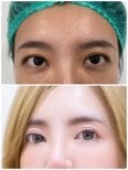 Before and after blepharoplasty results at ID Clinic Bangkok, eyelid correction procedure