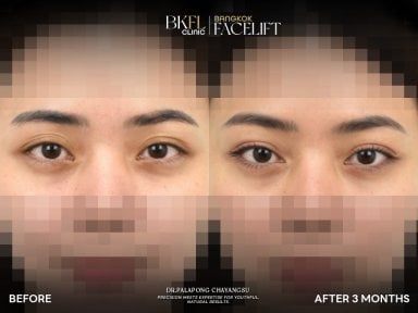 Результати блефаропластики до і після в клініці BKFL, корекція повік через 3 місяці