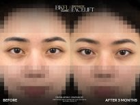 Результати блефаропластики до і після в клініці BKFL, корекція повік через 3 місяці