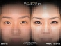 Résultats blépharoplastie avant/après à BKFL Clinic – correction des paupières après 6 mois