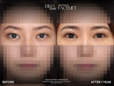 Before and after blepharoplasty results at BKFL Clinic, eyelid correction after 1 year