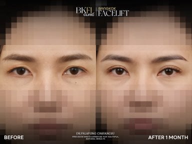 Блефаропластика до и после в клинике BKFL – результат коррекции век через 1 месяц