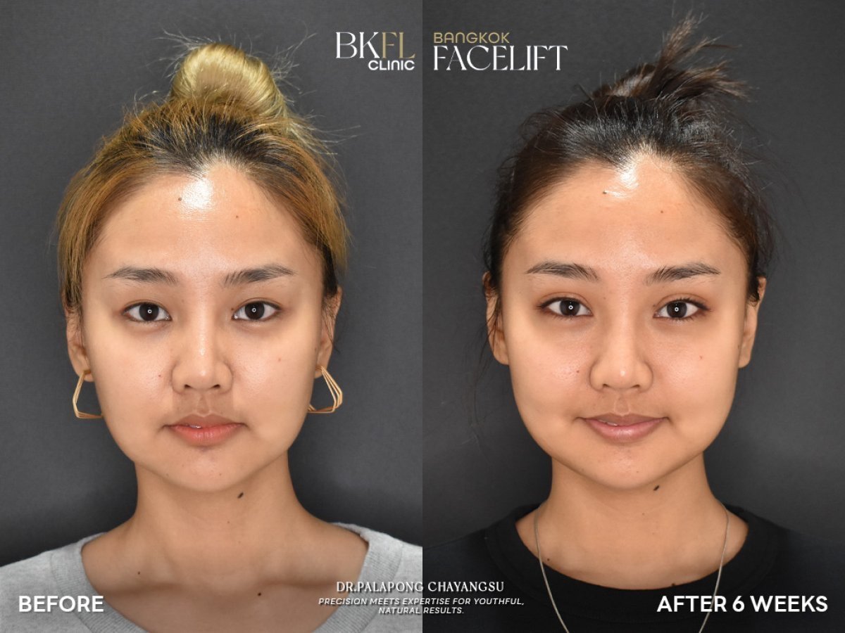 Vorher-nachher Facelift-Ergebnisse bei BKFL Clinic – sichtbare Verjüngung nach 6 Wochen