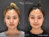 نتائج شد الوجه قبل وبعد في BKFL Clinic – تجديد شباب الوجه بعد 6 أسابيع