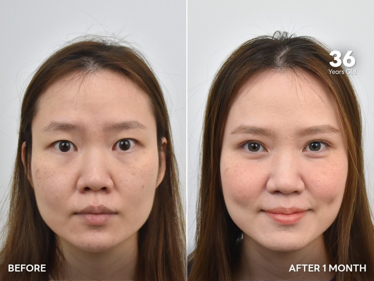 Vorher-nachher-Ergebnis der Blepharoplastik in der BKFL Clinic, sichtbare Lidkorrektur