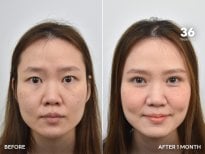 نتائج رأب الجفن قبل وبعد في BKFL Clinic، تحسن واضح في تصحيح الجفون