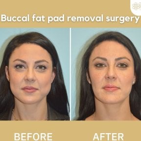 Before and after buccal fat extraction results at ID Clinic Bangkok, slimmer facial contour