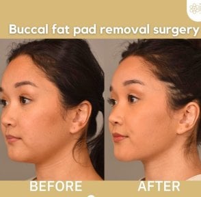 Before and after buccal fat extraction results at ID Clinic Bangkok, slimmer facial contour