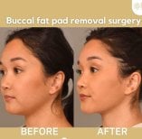 Before and after buccal fat extraction results at ID Clinic Bangkok, slimmer facial contour
