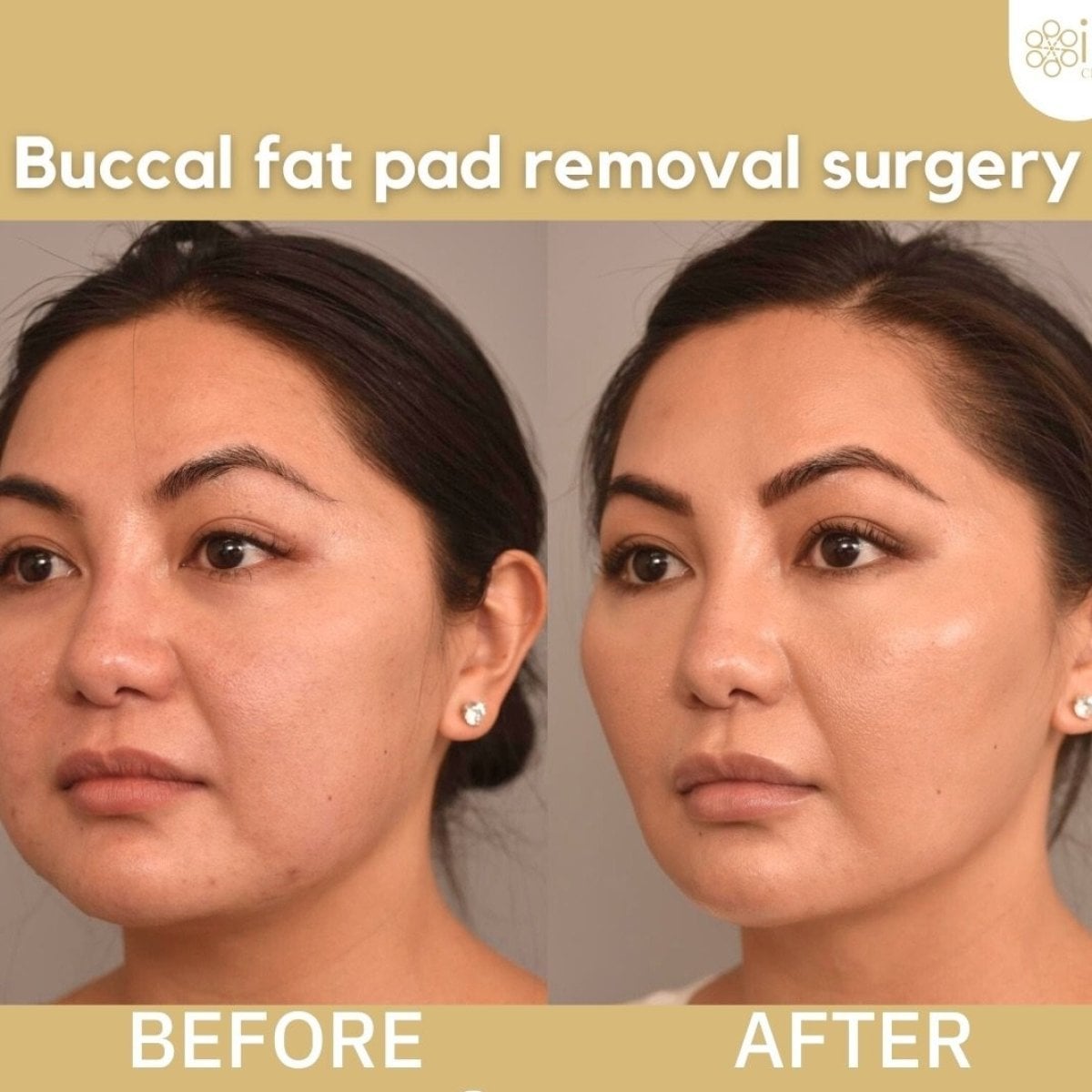Antes y después de extracción de grasa bucal en ID Clinic Bangkok – mejillas más delgadas