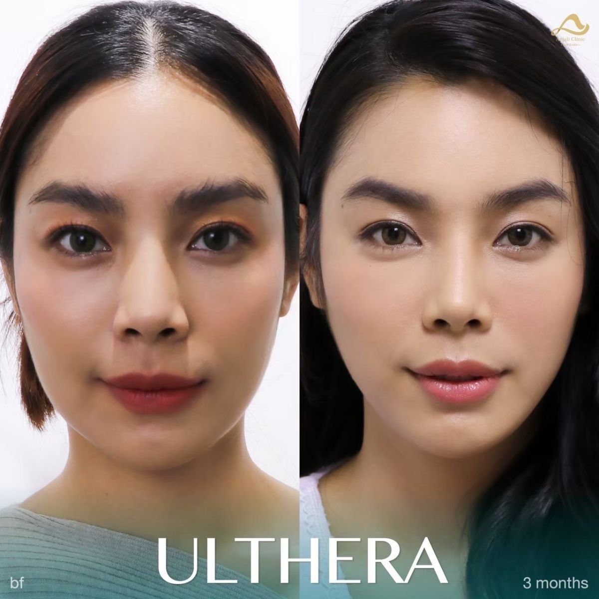 Resultados de Ultherapy antes y después en Anjali Clinic: lifting facial y piel más firme