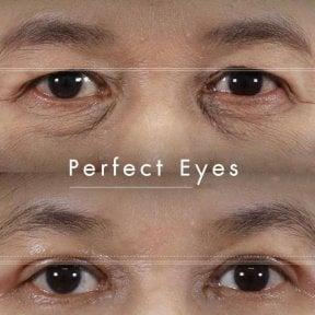Before and after blepharoplasty results at Wansiri Hospital, eyelid correction improvement