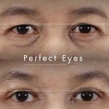 Before and after blepharoplasty results at Wansiri Hospital, eyelid correction improvement