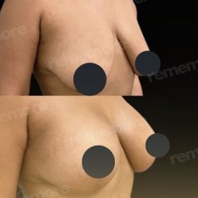 Before and after breast lift results at Memorial Şişli Hospital, improved breast contour
