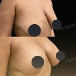 Before and after breast lift results at Memorial Şişli Hospital, improved breast contour