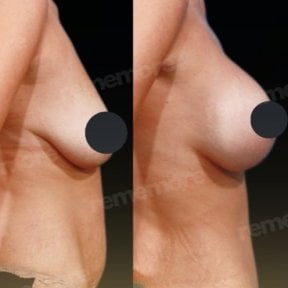 Before and after breast lift results at Memorial Şişli Hospital, visible breast contour improvement