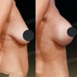 Before and after breast lift results at Memorial Şişli Hospital, visible breast contour improvement