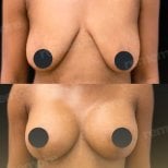 Before and after breast lift results at Memorial Şişli Hospital, improved breast contour