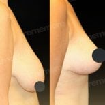 Before and after breast lift results at Memorial Şişli Hospital, improved breast contour