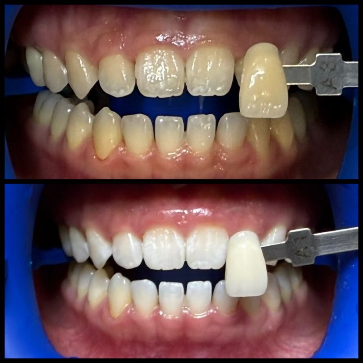 نتائج تبييض الأسنان قبل وبعد في Edelweiss Dental House، ابتسامة أكثر إشراقًا