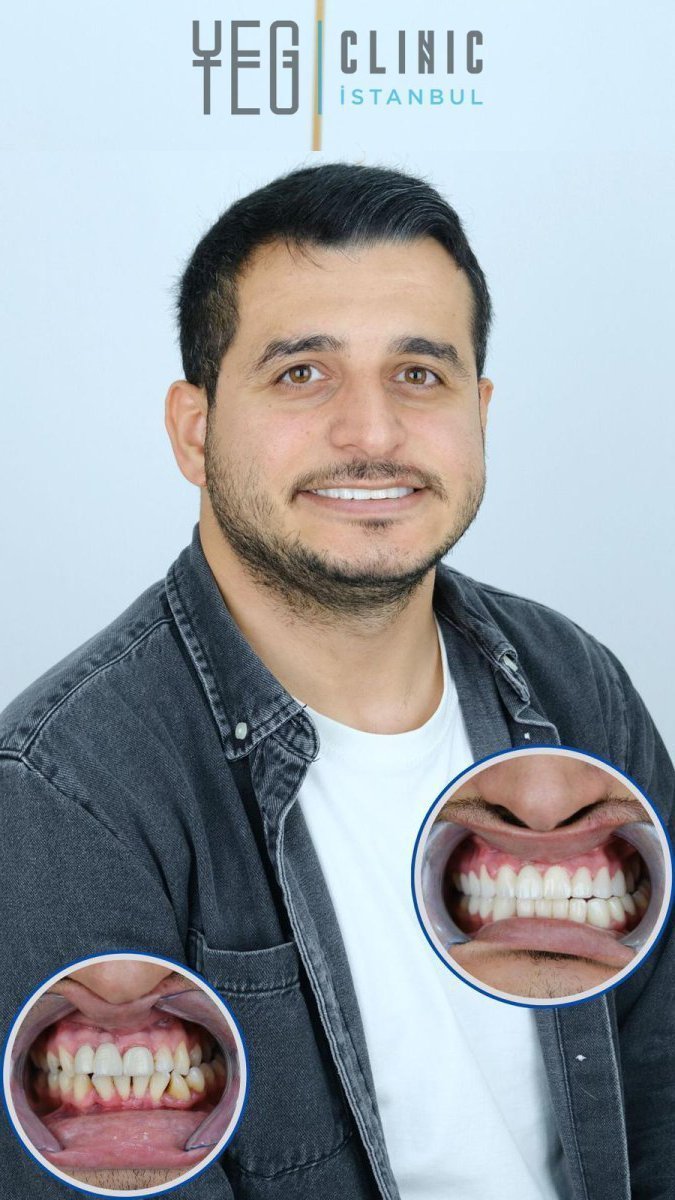نتائج قبل وبعد لومينير في YEG Clinic – ابتسامة محسنة وأسنان أكثر بياضًا