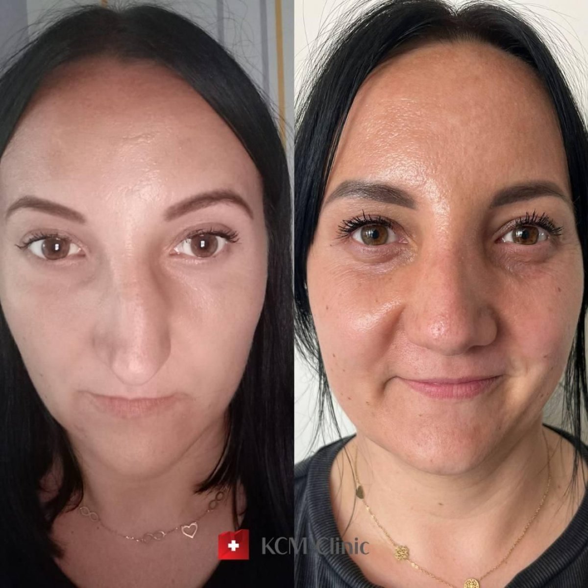 Resultados de septoplastia antes y después en KCM Clinic, mejor simetría y respiración nasal
