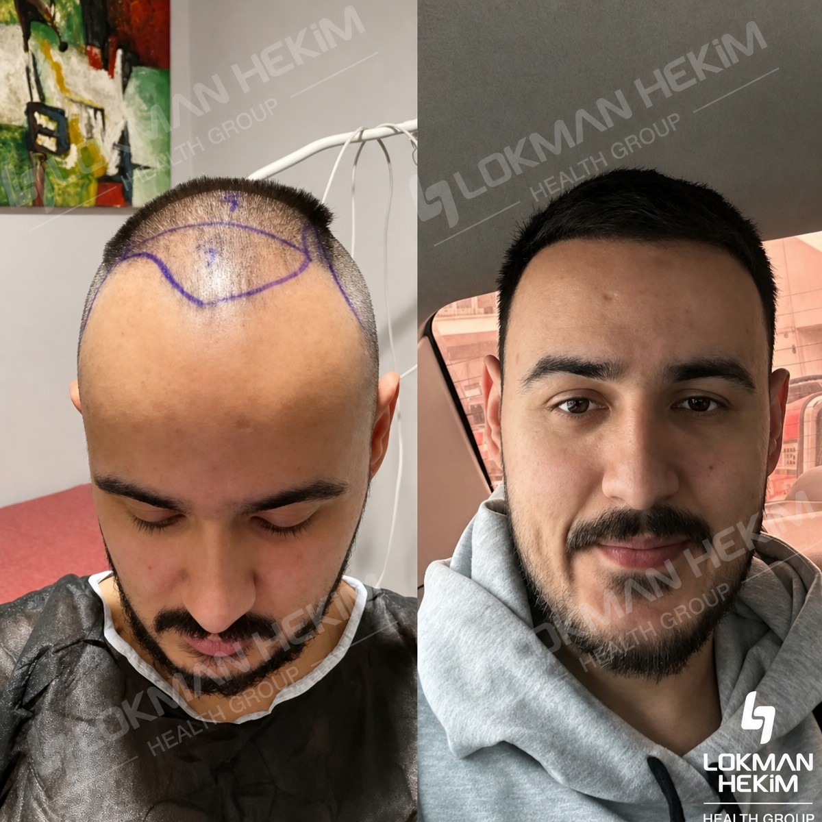 Resultados de trasplante capilar antes y después en Lokman Hekim Istanbul Hospital, línea restaurada