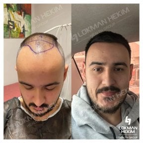 Before and after hair transplant results at Lokman Hekim Istanbul Hospital, restored hairline