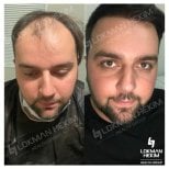 Before and after hair transplant results at Lokman Hekim Istanbul Hospital, restored hairline