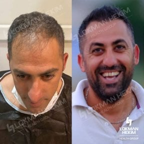 Before and after hair transplant results at Lokman Hekim Istanbul Hospital, restored hairline
