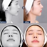 نتائج تجميل الأنف قبل وبعد في عيادة د. تشين، إعادة تشكيل الأنف بمظهر طبيعي