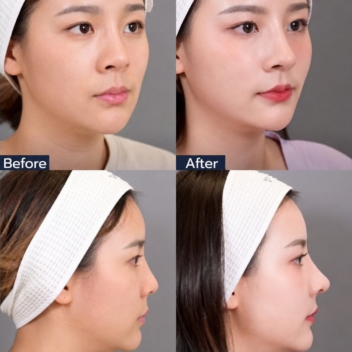 Resultados de rinoplastia antes y después en Dr. Chen Clinic, remodelación nasal natural