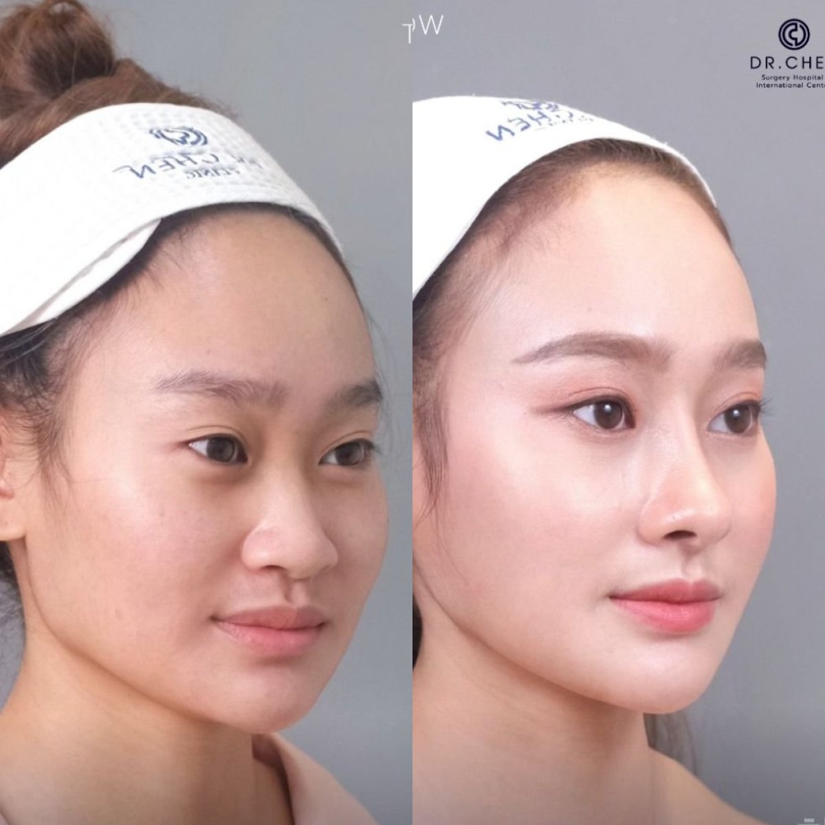 Resultados de rinoplastia antes y después en Dr. Chen Clinic, nariz de aspecto natural