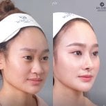 نتائج عملية تجميل الأنف قبل وبعد في عيادة Dr. Chen، إعادة تشكيل طبيعية للأنف