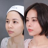 نتائج تجميل الأنف قبل وبعد في عيادة Dr. Chen، إعادة تشكيل الأنف بمظهر طبيعي