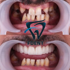 Before and after All-on-4 dental implants result at Dent48 Oral and Dental Health Polyclinics
