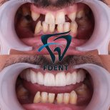 Before and after All-on-4 dental implants result at Dent48 Oral and Dental Health Polyclinics