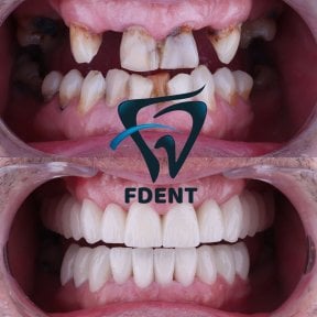 Результат до і після імплантації All-on-4 у Dent48 Oral and Dental Health Polyclinics