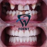 Результат до і після імплантації All-on-4 у Dent48 Oral and Dental Health Polyclinics