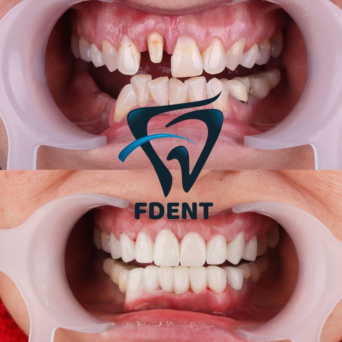 Before and after All-on-4 dental implants result at Dent48 Oral and Dental Health Polyclinics