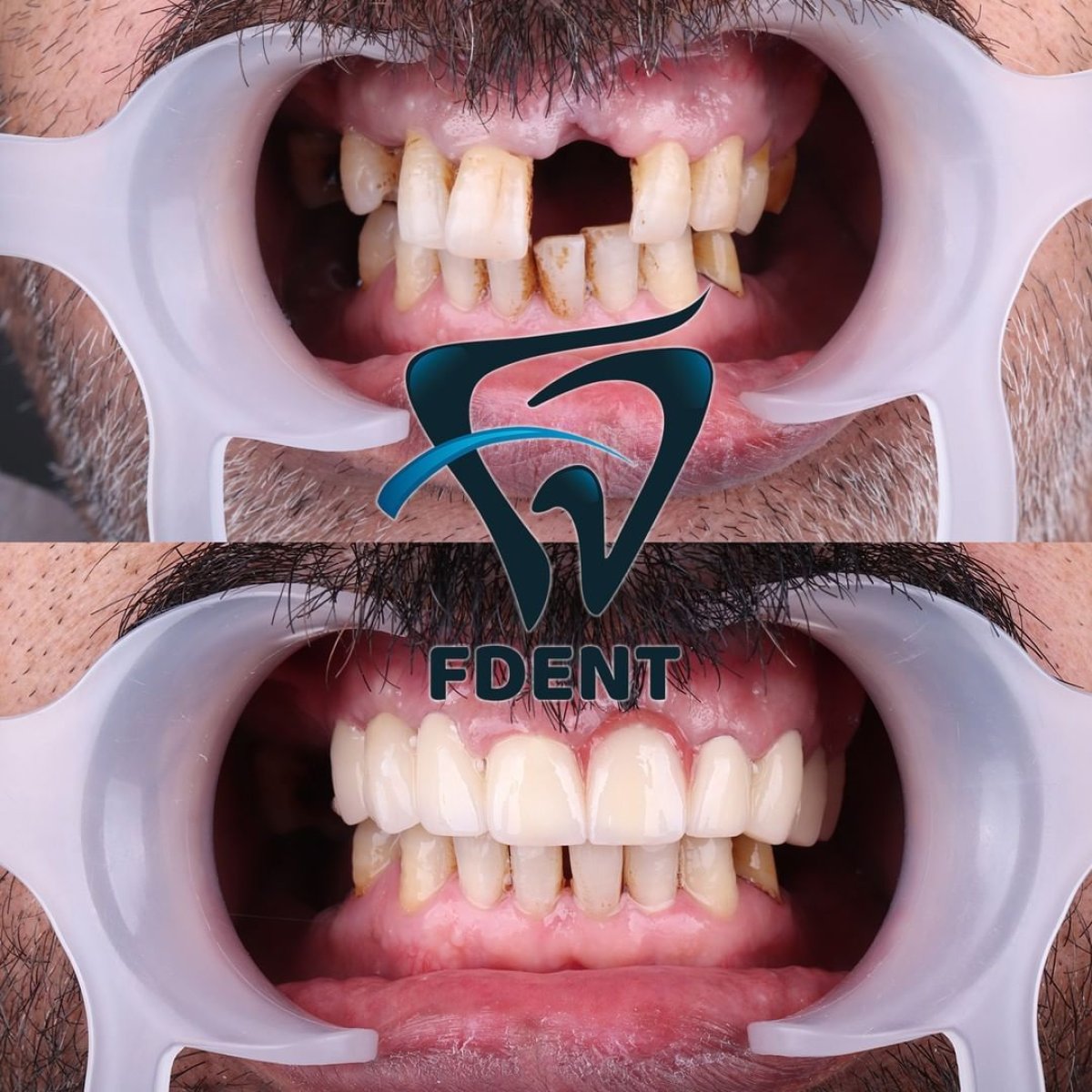 Before and after All-on-4 dental implants result at Dent48 Oral and Dental Health Polyclinics