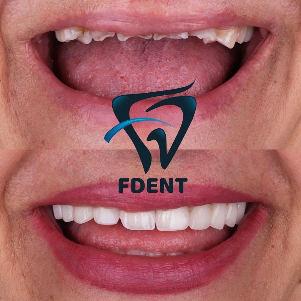 Before and after All-on-4 dental implants result at Dent48 Oral and Dental Health Polyclinics