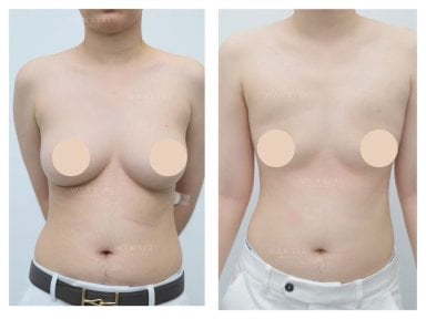 Before and after top surgery results at Wansiri Hospital, chest masculinization procedure