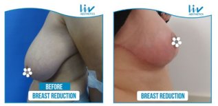 Vorher-nachher-Ergebnis Brustverkleinerung bei Liv Hospital Vadistanbul, verbesserte Form