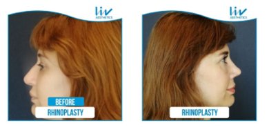 Vorher-nachher-Rhinoplastik-Ergebnisse bei Liv Hospital Vadistanbul, Nasenkorrektur