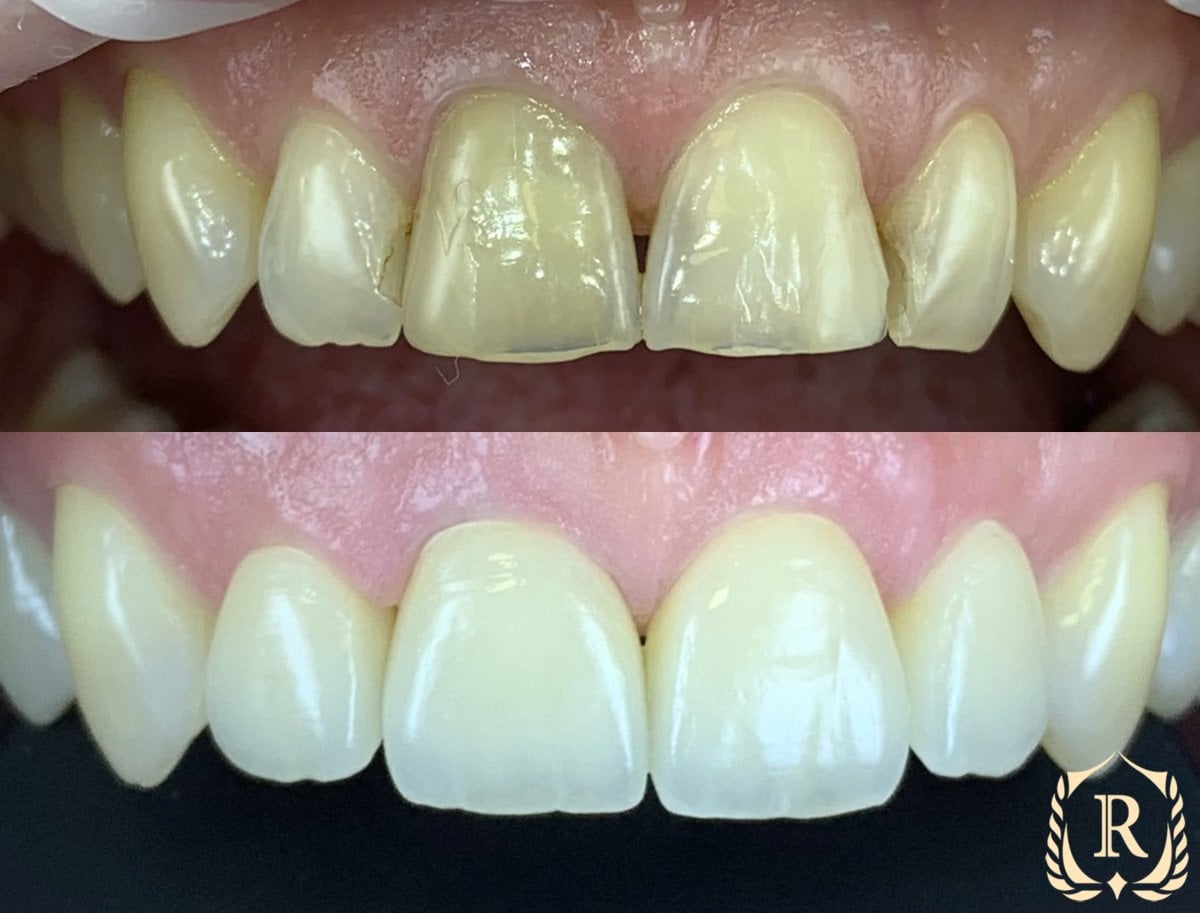 Antes y después de smile makeover en Rosental Dental – carillas dentales para estética mejorada