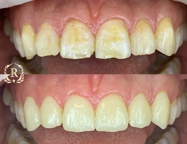 Résultats avant/après du relooking du sourire chez Rosental Dental – couleur et forme améliorées
